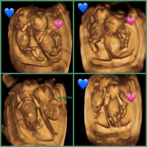 21 week ultrasound boy